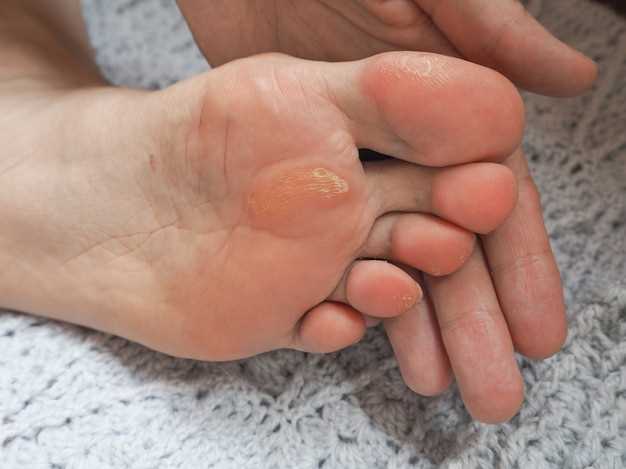Домашние процедуры и правила гигиены для успешного избавления от грибка ногтей
